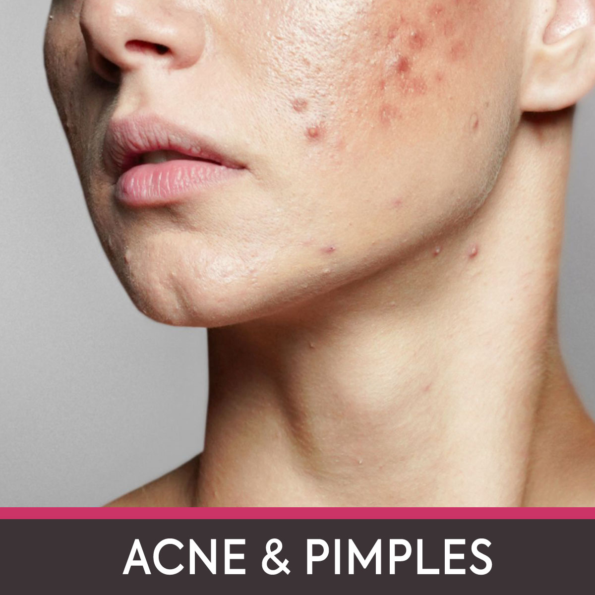 Acne & Pimples 