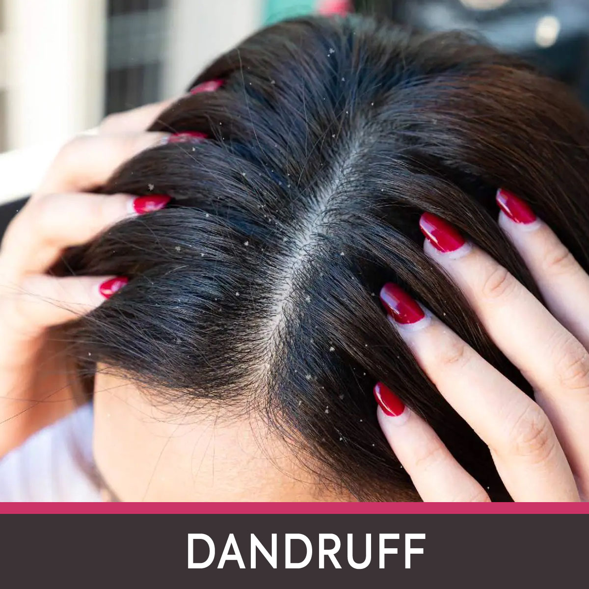 dandruff